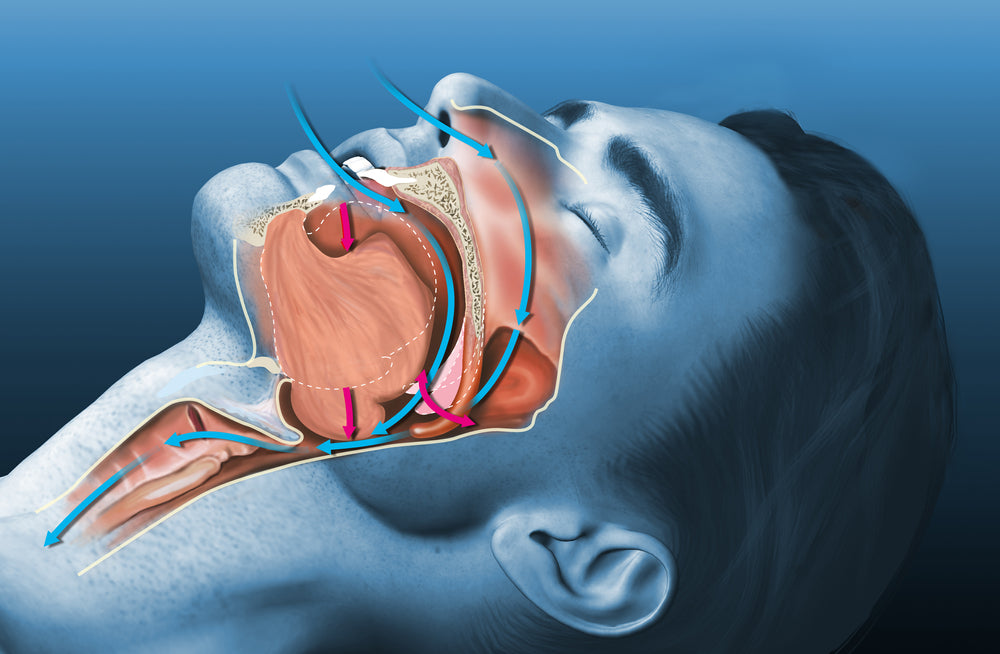 Does mouth tape help against snoring?